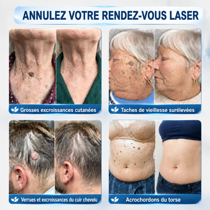 👩‍⚕️👍 𝐵𝑜𝑢𝑡𝑖𝑞𝑢𝑒 𝑂𝑓𝑓𝑖𝑐𝑖𝑒𝑙𝑙𝑒 | 𝑵𝐞𝒌𝐢𝐬𝐬® 🌿𝑴𝒊𝒄𝒓𝒐𝒏𝒆𝒆𝒅𝒍𝒆𝒔 𝑷𝒆𝒂𝒖 𝑷𝒂𝒓𝒇𝒂𝒊𝒕𝒆 É𝒍𝒊𝒎𝒊𝒏𝒂𝒕𝒊𝒐𝒏 𝑫𝒆𝒔 𝑽𝒆𝒓𝒓𝒖𝒆𝒔 𝑷𝒂𝒕𝒄𝒉 (𝑃𝑜𝑢𝑟 𝑙𝑒𝑠 𝑎𝑐𝑟𝑜𝑐ℎ𝑜𝑟𝑑𝑜𝑛𝑠, 𝑙𝑒𝑠 𝑝𝑒𝑡𝑖𝑡𝑒𝑠 𝑒𝑥𝑐𝑟𝑜𝑖𝑠𝑠𝑎𝑛𝑐𝑒𝑠 𝑐𝑢𝑡𝑎𝑛é𝑒𝑠, 𝑙𝑒𝑠 𝑣𝑒𝑟𝑟𝑢𝑒𝑠, 𝑙𝑒𝑠 𝑔𝑟𝑎𝑖𝑛𝑠 𝑑𝑒 𝑏𝑒𝑎𝑢𝑡é, 𝑙𝑒𝑠 𝑡𝑎𝑐ℎ𝑒𝑠 𝑑𝑒 𝑣𝑖𝑒𝑖𝑙𝑙𝑒𝑠𝑠𝑒 𝑒𝑡 𝑙𝑒𝑠 𝑝𝑟𝑜𝑏𝑙è𝑚𝑒𝑠 𝑑𝑒 𝑝𝑖𝑔𝑚𝑒𝑛𝑡𝑎𝑡𝑖𝑜𝑛)