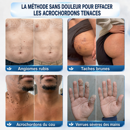 👩‍⚕️👍 𝐵𝑜𝑢𝑡𝑖𝑞𝑢𝑒 𝑂𝑓𝑓𝑖𝑐𝑖𝑒𝑙𝑙𝑒 | 𝑵𝐞𝒌𝐢𝐬𝐬® 🌿𝑴𝒊𝒄𝒓𝒐𝒏𝒆𝒆𝒅𝒍𝒆𝒔 𝑷𝒆𝒂𝒖 𝑷𝒂𝒓𝒇𝒂𝒊𝒕𝒆 É𝒍𝒊𝒎𝒊𝒏𝒂𝒕𝒊𝒐𝒏 𝑫𝒆𝒔 𝑽𝒆𝒓𝒓𝒖𝒆𝒔 𝑷𝒂𝒕𝒄𝒉 (𝑃𝑜𝑢𝑟 𝑙𝑒𝑠 𝑎𝑐𝑟𝑜𝑐ℎ𝑜𝑟𝑑𝑜𝑛𝑠, 𝑙𝑒𝑠 𝑝𝑒𝑡𝑖𝑡𝑒𝑠 𝑒𝑥𝑐𝑟𝑜𝑖𝑠𝑠𝑎𝑛𝑐𝑒𝑠 𝑐𝑢𝑡𝑎𝑛é𝑒𝑠, 𝑙𝑒𝑠 𝑣𝑒𝑟𝑟𝑢𝑒𝑠, 𝑙𝑒𝑠 𝑔𝑟𝑎𝑖𝑛𝑠 𝑑𝑒 𝑏𝑒𝑎𝑢𝑡é, 𝑙𝑒𝑠 𝑡𝑎𝑐ℎ𝑒𝑠 𝑑𝑒 𝑣𝑖𝑒𝑖𝑙𝑙𝑒𝑠𝑠𝑒 𝑒𝑡 𝑙𝑒𝑠 𝑝𝑟𝑜𝑏𝑙è𝑚𝑒𝑠 𝑑𝑒 𝑝𝑖𝑔𝑚𝑒𝑛𝑡𝑎𝑡𝑖𝑜𝑛)