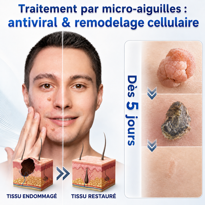 👩‍⚕️👍 𝐵𝑜𝑢𝑡𝑖𝑞𝑢𝑒 𝑂𝑓𝑓𝑖𝑐𝑖𝑒𝑙𝑙𝑒 | 𝑵𝐞𝒌𝐢𝐬𝐬® 🌿𝑴𝒊𝒄𝒓𝒐𝒏𝒆𝒆𝒅𝒍𝒆𝒔 𝑷𝒆𝒂𝒖 𝑷𝒂𝒓𝒇𝒂𝒊𝒕𝒆 É𝒍𝒊𝒎𝒊𝒏𝒂𝒕𝒊𝒐𝒏 𝑫𝒆𝒔 𝑽𝒆𝒓𝒓𝒖𝒆𝒔 𝑷𝒂𝒕𝒄𝒉 (𝑃𝑜𝑢𝑟 𝑙𝑒𝑠 𝑎𝑐𝑟𝑜𝑐ℎ𝑜𝑟𝑑𝑜𝑛𝑠, 𝑙𝑒𝑠 𝑝𝑒𝑡𝑖𝑡𝑒𝑠 𝑒𝑥𝑐𝑟𝑜𝑖𝑠𝑠𝑎𝑛𝑐𝑒𝑠 𝑐𝑢𝑡𝑎𝑛é𝑒𝑠, 𝑙𝑒𝑠 𝑣𝑒𝑟𝑟𝑢𝑒𝑠, 𝑙𝑒𝑠 𝑔𝑟𝑎𝑖𝑛𝑠 𝑑𝑒 𝑏𝑒𝑎𝑢𝑡é, 𝑙𝑒𝑠 𝑡𝑎𝑐ℎ𝑒𝑠 𝑑𝑒 𝑣𝑖𝑒𝑖𝑙𝑙𝑒𝑠𝑠𝑒 𝑒𝑡 𝑙𝑒𝑠 𝑝𝑟𝑜𝑏𝑙è𝑚𝑒𝑠 𝑑𝑒 𝑝𝑖𝑔𝑚𝑒𝑛𝑡𝑎𝑡𝑖𝑜𝑛)